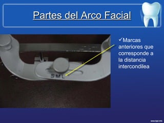 Partes del Arco Facial Marcas anteriores que corresponde a la distancia intercondilea 