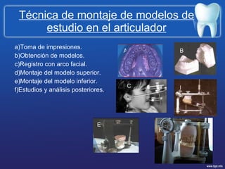 Técnica de montaje de modelos de estudio en el articulador a)Toma de impresiones. b)Obtención de modelos. c)Registro con arco facial. d)Montaje del modelo superior. e)Montaje del modelo inferior. f)Estudios y análisis posteriores. . A B C D E F 