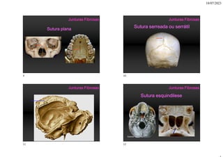 18/07/2023
Sutura plana
Junturas Fibrosas
Sutura serreada ou serrátil
Junturas Fibrosas
Sutura escamosa
Junturas Fibrosas
Sutura esquindilese
Junturas Fibrosas
Sobotta
9 10
11 12
 