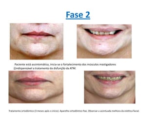 Fase 2
Paciente está assintomática, inicia-se o fortalecimento dos músculos mastigadores
((indispensável a tratamento da disfunção da ATM.
Tratamento ortodôntico (3 meses após o início). Aparelho ortodôntico fixo. Observar a acentuada melhora da estética facial.
 