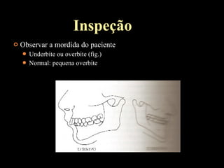  Observar a mordida do paciente
 Underbite ou overbite (fig.)
 Normal: pequena overbite
Inspeção
 