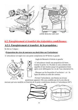 6.2. Enregistrement et transfert des trajectoires condyliennes:
6.2.1. Enregistrement et transfert de la propulsion :
Se fait en 3 étapes :
-Préparation des cires de morsures ou check bites sur l’articulateur.
-L’articulateur est réglé avec une pente condylienne de 44°droite et gauche
                                         Angle de Bennett à 0 droite et gauche
                                        -L’articulateur simule une propulsion de 6mm :
                                        tourner la petite vis 14a dans le sens contraire des
                                        aiguilles d’une montre jusqu’à la graduation 6mm
                                        après avoir débloquées les vis de l’axe charnière(13).
                                         -Marquer sur les bourrelets d’occlusion > et < la
                                        ligne du milieu et celle des canines.
                                       -Fermer l’articulateur, une béance au niveau
                           postérieure apparait. Elle sera comblée par de la cire dite de
morsure qui sera modelée en fonction de la pente condylienne donnée à l’articulateur (44°).




                                             12
 