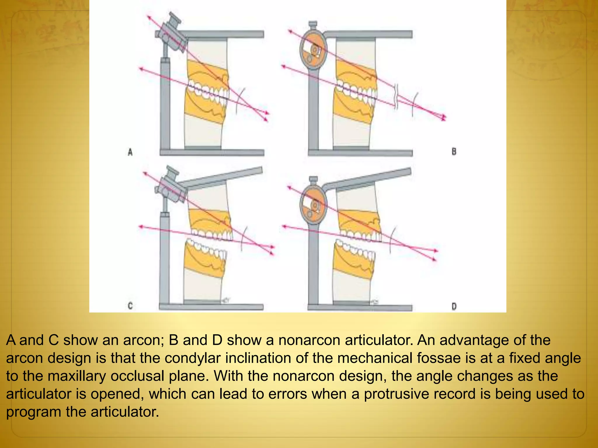 A and C show an arcon; B and D show a nonarcon articulator. An advantage of the
arcon design is that the condylar inclination of the mechanical fossae is at a fixed angle
to the maxillary occlusal plane. With the nonarcon design, the angle changes as the
articulator is opened, which can lead to errors when a protrusive record is being used to
program the articulator.
 