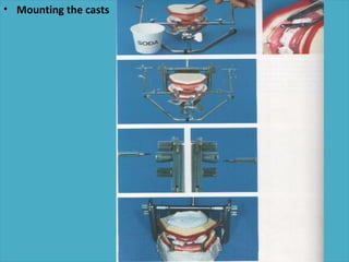 • Mounting the casts




  .
 