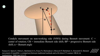 Condyle movement on non-working side (NWS) during Bennett movement: C =
center of rotation; CB = immediate Bennett side shift; BP = progressive Bennett side
shift; α = Bennett angle
Fanucci E, Spera E, Ottria L, Barlattani Jr A, Fusco N, Mylonakou I, Broccoli P, Barlattani A, Simonetti G. Bennett
movement of mandible: a comparison between traditional methods and a 64-slices CT scanner. ORAL &
implantology. 2008 Apr;1(1):15.
 