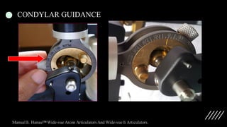 CONDYLAR GUIDANCE
 