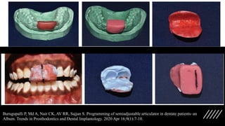 Burugupalli P, Md A, Nair CK, AV RR, Sajjan S. Programming of semiadjustable articulator in dentate patients–an
Album. Trends in Prosthodontics and Dental Implantology. 2020 Apr 16;9(1):7-10.
 