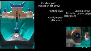 Condylar path
inclination set screw
Pivoting lever
Condylar path
calibrations
Bennet
calibrations
Locking screw
of bennet angle
 