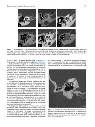 Otoesclerosis: revisión de diversos aspectos 111
Figura 1 Graduación por TC de la otoesclerosis. Clasiﬁcación de Symons y Fanning13
para graduar el compromiso de la otoesclero-
sis. Grado 0: Normal. Grado 1: Solo compromiso fenestral. Grado 2: Compromiso coclear parcheado (2a: giro basal; 2b: ápice/giro
medio; 2c: giro basal y ápice/giro medio). Grado 3: Compromiso coclear difuso. Todas las imágenes corresponden a cortes axiales
de oído derecho en el nivel de la cóclea. Las cabezas de ﬂecha se˜nalan las áreas de hueso espongiótico.
práctica clínica3
. Se resume la clasiﬁcación en la tabla 3, y
se presentan ejemplos de los distintos grados en la ﬁgura 1.
El tratamiento quirúrgico de la otoesclerosis fenestral
consiste en estapedectomía con instalación de prótesis de
estribo, esta última fabricada normalmente con elementos
radiodensos que permiten su control imagenológico (ﬁg. 2).
Dentro de las complicaciones posquirúrgicas precoces se
cuenta la fístula perilinfática, reacción a cuerpo extra˜no
con formación de granuloma y laberintitis seroﬁbrinoide
o supurativa. En muchas de estas complicaciones la RM
cobra relevancia como examen complementario para la
pesquisa15
.
Es importante saber que aquellos pacientes que pre-
sentan pérdida de audición posterior a la cirugía deben
ser evaluados cuidadosamente con TC para descartar mal-
funcionamiento de la prótesis de estribo por subluxación,
migración o fractura de esta. La subluxación de la prótesis se
ha descrito hasta en un 50% de los pacientes con pérdida de
audición reciente poscirugía. No todos los pacientes se bene-
ﬁciarán de una reexploración quirúrgica, ya que una nueva
instrumentalización constituye un factor de riesgo para pro-
gresión hacia hipoacusia sensorio-neural. La formación de
nuevo hueso espongiótico en la zona tratada en pacientes
con otoesclerosis progresiva o aquellos que han sido someti-
dos a perforación extensa de la base del estribo son factores
que contraindican una nueva cirugía16
.
El diagnóstico diferencial de la otoesclerosis fenestral
es amplio. Debe considerarse la otitis media crónica con
timpanoesclerosis, pero la presencia de cambios inﬂama-
torios en el oído medio y la escasa neumatización de la
mastoides orientan a su diagnóstico. Otra posibilidad es
la enfermedad de Paget, pero el segmento etario de esta
enfermedad es mayor (50-60 a˜nos) y además el compromiso
del hueso temporal es más difuso, existiendo la mayoría
de las veces compromiso que va más allá de la cápsula
ótica. La osteogénesis imperfecta también constituye diag-
nóstico diferencial, y distinguirla de la otoesclerosis puede
Figura 2 Prótesis de estribo. Prótesis parcial de estribo en
paciente con otoesclerosis fenestral tratada. La imagen corres-
ponde a una reconstrucción coronal oblicua del oído derecho.
La ﬂecha se˜nala la prótesis, que se encuentra bien situada a
nivel de la ventana oval.
 