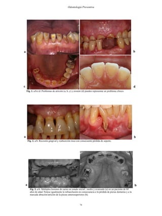 76
Odontología Preventiva
Fig. 1. a/b/c/d: Problemas de atrición (a, b, c) y erosión (d) pueden representar un problema clínico.
a b
c d
Fig. 2. a/b: Recesión gingival y reabsorción ósea con consecuente pérdida de soporte.
Fig. 3. a/b: Múltiples lesiones de caries en estado inicial , medio y avanzado (a) en un paciente de 68
años de edad. Notese igualmente la infraoclusión en consecuencia a la pérdida de piezas dentarias y a la
marcada abración/atrición de la piezas anterosuperiores (b).
a
a
b
b
 