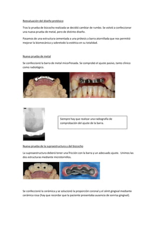 Reevaluación del diseño protésico

Tras la prueba de bizcocho realizada se decidió cambiar de rumbo. Se volvió a confeccionar
una nueva prueba de metal, pero de distinto diseño.

Pasamos de una estructura cementada a una prótesis a barra atornillada que nos permitió
mejorar la biomecánica y sobretodo la estética en su totalidad.



Nueva prueba de metal

Se confeccionó la barra de metal micorfresada. Se comprobó el ajuste pasivo, tanto clínico
como radiológico.




                               Siempre hay que realizar una radiografía de
                               comprobación del ajuste de la barra.




Nueva prueba de la supraestructura y del bizcocho

La supreaestructura deberá tener una fricción con la barra y un adecuado ajuste. Unimos las
dos estructuras mediante microtornillos.




Se confeccionó la cerámica y se solucionó la proporción coronal y el zénit gingival mediante
cerámica rosa (hay que recordar que la paciente presentaba ausencia de sonrisa gingival).
 