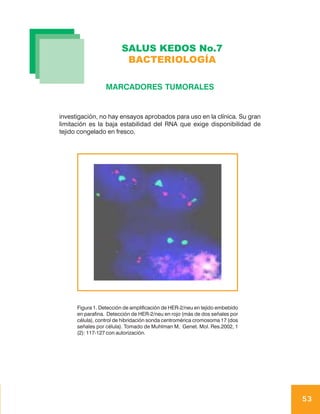 SALUS KEDOS No.7
                         BACTERIOLOGÍA

                  MARCADORES TUMORALES


investigación, no hay ensayos aprobados para uso en la clínica. Su gran
limitación es la baja estabilidad del RNA que exige disponibilidad de
tejido congelado en fresco.




      Figura 1. Detección de amplificación de HER-2/neu en tejido embebido
      en parafina. Detección de HER-2/neu en rojo (más de dos señales por
      célula), control de hibridación sonda centromérica cromosoma 17 (dos
      señales por célula). Tomado de Muhlman M, Genet. Mol. Res.2002, 1
      (2): 117-127 con autorización.




                                                                             53
 
