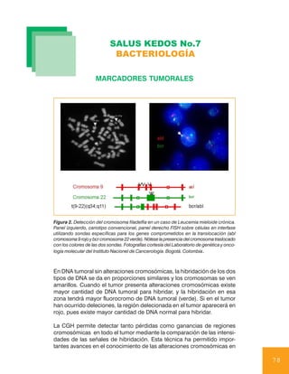 SALUS KEDOS No.7
                             BACTERIOLOGÍA

                     MARCADORES TUMORALES




Figura 2. Detección del cromosoma filadelfia en un caso de Leucemia mieloide crónica.
Panel izquierdo, cariotipo convencional, panel derecho FISH sobre células en interfase
utilizando sondas específicas para los genes comprometidos en la translocación (abl
cromosoma 9 rojo y bcr cromosoma 22 verde). Nótese la presencia del cromosoma traslocado
con los colores de las dos sondas. Fotografías cortesía del Laboratorio de genética y onco-
logía molecular del Instituto Nacionel de Cancerología. Bogotá. Colombia.



En DNA tumoral sin alteraciones cromosómicas, la hibridación de los dos
tipos de DNA se da en proporciones similares y los cromosomas se ven
amarillos. Cuando el tumor presenta alteraciones cromosómicas existe
mayor cantidad de DNA tumoral para hibridar, y la hibridación en esa
zona tendrá mayor fluorocromo de DNA tumoral (verde). Si en el tumor
han ocurrido deleciones, la región delecionada en el tumor aparecerá en
rojo, pues existe mayor cantidad de DNA normal para hibridar.

La CGH permite detectar tanto pérdidas como ganancias de regiones
cromosómicas en todo el tumor mediante la comparación de las intensi-
dades de las señales de hibridación. Esta técnica ha permitido impor-
tantes avances en el conocimiento de las alteraciones cromosómicas en

                                                                                              78
 