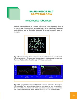 SALUS KEDOS No.7
                            BACTERIOLOGÍA

                    MARCADORES TUMORALES


cáncer, particularmente en tumores sólidos, en los que es muy difícil la
obtención de metafases. En las figuras 3a y 3b se presenta un ejemplo
de CGH en el que se detectó la presencia de un cromosoma X supernu-
merario.




Figura 3a. Hibridación genómica comparativa de una metafase humana. Resultados de
un caso de múltiples X. (Nótese la señal más intensa en los cromosomas X y x). Tomado de
Muhlmann M, Genet. Mol. Res.2002 1 (2): 117-127 con autorización.




Figura 3b. Ejemplos del análisis de la hibridación genómica comparativa. Panel izquier-
do, Cromosoma uno: señal normal con relación rojo / verde de uno. Panel derecho:
Cromosoma X con relación rojo verde de 2,5, lo que indica presencia de un supernumera-
rio. Tomado de Muhlmann M, Genet. Mol. Res.2002 1 (2): 117-127 con autorización.



                                                                                           79
 