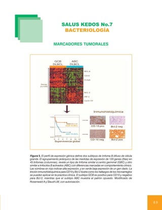 SALUS KEDOS No.7
                             BACTERIOLOGÍA

                     MARCADORES TUMORALES




Figura 5. El perfil de expresión génica define dos subtipos de linfoma B difuso de célula
grande. El agrupamiento jerárquico de las medidas de expresión de 120 genes (filas) en
45 linfomas (columnas), revela un tipo de linfoma similar a centro germinal (GBC) y otro
similar a linfocitos B activados (ABC) con diferencias marcadas en comportamiento clínico.
Las sombras en rojo indican alta expresión, y en verde baja expresión de un gen dado. La
tinción inmunohistoquímica para CD10 y Bcl-2 ilustra como los hallazgos de los microarreglos
se pueden aplicar en la practica clínica. El subtipo GCB es positivo para CD10 y negativo
para Bcl-2, mientras que el subtipo ABC muestra el patrón opuesto. Modificado de
Rosenwald A y Staudt LM, con autorización.




                                                                                               89
 