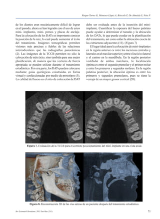 71Rev Estomatol Herediana. 2015 Ene-Mar;25(1).
de los dientes eran mecánicamente difícil de lograr
en el pasado, ahora se han logrado con el uso de estos
mini- implantes, mini- pernos y placas de anclaje.
Para la colocación de los DATs es importante conocer
la posición de la raíz, lo cual puede aumentar el éxito
del tratamiento. Imágenes tomográficas permiten
visiones más precisas y fiables de las relaciones
interradiculares que las radiografías panorámicas
(2). Las imágenes de la TCCB permiten no sólo la
colocación de más éxito, sino también para una mejor
planificación, de manera que los vectores de fuerza
apropiada se pueden utilizar durante el tratamiento
ortodóntico. Por otra parte, los DATs pueden colocarse
mediante guías quirúrgicas construidas en forma
virtual y confeccionadas por medio de prototipos (3).
La calidad del hueso en el sitio de colocación de DAT
debe ser evaluada antes de la inserción del mini-
implante. Cuantificar la espesura del hueso palatino
puede ayudar a determinar el tamaño y la ubicación
de los DATs, lo que puede ayudar en la planificación
del tratamiento, así como saber la ubicación exacta de
las estructuras adyacentes (11). (Figura 7)
	 El lugar ideal para la colocación de mini-implantes
en la región anterior es entre los incisivos centrales y
lateralesenelmaxilarsuperioryentreelincisivolateral
y el canino en la mandíbula. En la región posterior
vestibular de ambos maxilares, la localización
óptima es entre el segundo premolar y el primer molar
y entre los primeros y segundos molares. En la región
palatina posterior, la ubicación óptima es entre los
primeros y segundos premolares, pues se tiene la
ventaja de un mayor grosor cortical (20).
Figura 7. Evaluación de la TCCB para el correcto posicionamiento del mini-implante en una vista axial.
Figura 8. Reconstrucción 3D de las vías aéreas de un paciente después del tratamiento ortodóntico.
Roque-Torres G, Meneses-López A, Bóscolo F, De Almeida S, Neto F.
 