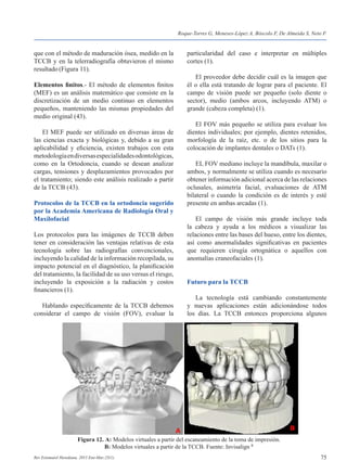 75Rev Estomatol Herediana. 2015 Ene-Mar;25(1).
que con el método de maduración ósea, medido en la
TCCB y en la telerradiografía obtuvieron el mismo
resultado(Figura 11).
Elementos finitos.- El método de elementos finitos
(MEF) es un análisis matemático que consiste en la
discretización de un medio continuo en elementos
pequeños, manteniendo las mismas propiedades del
medio original (43).
	 El MEF puede ser utilizado en diversas áreas de
las ciencias exacta y biológicas y, debido a su gran
aplicabilidad y eficiencia, existen trabajos con esta
metodologíaendiversasespecialidadesodontológicas,
como en la Ortodoncia, cuando se desean analizar
cargas, tensiones y desplazamientos provocados por
el tratamiento; siendo este análisis realizado a partir
de la TCCB (43).
Protocolos de la TCCB en la ortodoncia sugerido
por la Academia Americana de Radiología Oral y
Maxilofacial
Los protocolos para las imágenes de TCCB deben
tener en consideración las ventajas relativas de esta
tecnología sobre las radiografías convencionales,
incluyendo la calidad de la información recopilada, su
impacto potencial en el diagnóstico, la planificación
del tratamiento, la facilidad de su uso versus el riesgo,
incluyendo la exposición a la radiación y costos
financieros (1).
	 Hablando específicamente de la TCCB debemos
considerar el campo de visión (FOV), evaluar la
particularidad del caso e interpretar en múltiples
cortes (1).
	 El proveedor debe decidir cuál es la imagen que
él o ella está tratando de lograr para el paciente. El
campo de visión puede ser pequeño (solo diente o
sector), medio (ambos arcos, incluyendo ATM) o
grande (cabeza completa) (1).
	 El FOV más pequeño se utiliza para evaluar los
dientes individuales; por ejemplo, dientes retenidos,
morfología de la raíz, etc. o de los sitios para la
colocación de implantes dentales o DATs (1).
	 EL FOV mediano incluye la mandíbula, maxilar o
ambos, y normalmente se utiliza cuando es necesario
obtener información adicional acerca de las relaciones
oclusales, asimetría facial, evaluaciones de ATM
bilateral o cuando la condición es de interés y esté
presente en ambas arcadas (1).
	 El campo de visión más grande incluye toda
la cabeza y ayuda a los médicos a visualizar las
relaciones entre las bases del hueso, entre los dientes,
así como anormalidades significativas en pacientes
que requieren cirugía ortognática o aquellos con
anomalías craneofaciales (1).
Futuro para la TCCB
	 La tecnología está cambiando constantemente
y nuevas aplicaciones están adicionándose todos
los días. La TCCB entonces proporciona algunos
Figura 12. A: Modelos virtuales a partir del escaneamiento de la toma de impresión.
B: Modelos virtuales a partir de la TCCB. Fuente: Invisalign R
Roque-Torres G, Meneses-López A, Bóscolo F, De Almeida S, Neto F.
 