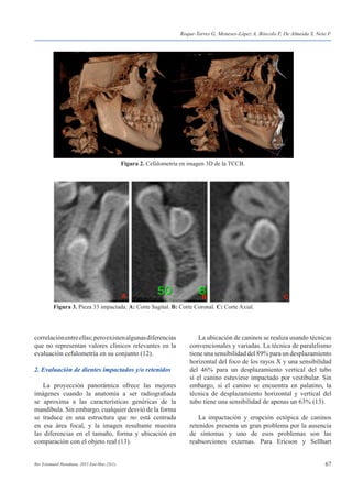 67Rev Estomatol Herediana. 2015 Ene-Mar;25(1).
correlaciónentreellas;peroexistenalgunasdiferencias
que no representan valores clínicos relevantes en la
evaluación cefalometría en su conjunto (12).
2. Evaluación de dientes impactados y/o retenidos
	 La proyección panorámica ofrece las mejores
imágenes cuando la anatomía a ser radiografiada
se aproxima a las características genéricas de la
mandíbula. Sin embargo, cualquier desvió de la forma
se traduce en una estructura que no está centrada
en esa área focal, y la imagen resultante muestra
las diferencias en el tamaño, forma y ubicación en
comparación con el objeto real (13).
	 La ubicación de caninos se realiza usando técnicas
convencionales y variadas. La técnica de paralelismo
tiene una sensibilidad del 89% para un desplazamiento
horizontal del foco de los rayos X y una sensibilidad
del 46% para un desplazamiento vertical del tubo
si el canino estuviese impactado por vestibular. Sin
embargo, si el canino se encuentra en palatino, la
técnica de desplazamiento horizontal y vertical del
tubo tiene una sensibilidad de apenas un 63% (13).
	 La impactación y erupción ectópica de caninos
retenidos presenta un gran problema por la ausencia
de síntomas y uno de esos problemas son las
reabsorciones externas. Para Ericson y Sellhart
Roque-Torres G, Meneses-López A, Bóscolo F, De Almeida S, Neto F.
Figura 2. Cefalometría en imagen 3D de la TCCB.
Figura 3. Pieza 33 impactada. A: Corte Sagital. B: Corte Coronal. C: Corte Axial.
 