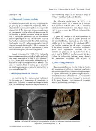 69Rev Estomatol Herediana. 2015 Ene-Mar;25(1).
evaluación (19).
4. ATM anatomía (normal y patología)
En relación con este tema la literatura es controversial
ya que hay poca información disponible sobre la
eficacia de los exámenes tomográficos en la mejora del
diagnóstico de los trastornos temporomandibulares
en comparación con la radiografía panorámica. En
la literatura se pueden encontrar obras que hablan
que la radiografía panorámica es una herramienta
inicialaceptable para evaluar las estructuras óseas de
la articulación temporomandibular (20). Sin embargo,
Korbmacher y col. (21) señalan que poca información
adicionalsepuedeobtenerdelaTCCBencomparación
con los cambios morfológicos groseros que ya puede
mostrar la radiografía panorámica (Figura 4).
	 Cuando se comparó la TCCB, TC y radiografía
panorámicaencasosdeerosióndelcóndilo,seobservó
una mayor exactitud de la TCCB, 95% (dinámica)
y 77% (estático) en los escáneres tomográficos y el
65% en las proyecciones panorámicas. Frente a todo
esto, es necesario tener en cuenta que la extensión
de las alteraciones es proporcional a la duración y la
gravedad del dolor (20).
5. Morfología y reabsorción radicular
	 La mayoría de las reabsorciones radiculares
involucradas en el tratamiento de ortodoncia se
pueden ver fácilmente en las radiografías periapicales
(20,22). Sin embargo, la reabsorción que ocurre en el
lado vestibular y lingual de los dientes es difícil de
evaluar y cuantificar en la vista 2D (20).
	 La diferencia media entre la TCCB y la
visualización directa de la medida de la longitud
de la raíz es de 0,05 mm (DP + / - 0,75), diferencia
estadísticamente significativa para algunas raíces. In
vivo: el error es menor que 0,35 mm (tratamiento pre
y post) (23).
	 A pesar del cambio en el posicionamiento de
los dientes, la TCCB por lo general produce una
alta reproducibilidad, mejorando de este modo su
utilidad en la investigación de ortodoncia (23) y
los estudios muestran que el mayor movimiento
de los dientes después del tratamiento ortodóntico
puede estar directamente asociado con un
aumento de gravedad de la reabsorción de la
raíz y que la TCCB es una herramienta útil para
evaluar la reabsorción radicular apical después
del tratamiento ortodóntico (24) (Figura 5).
6. Dehiscencia y fenestración
	 La espesura de la cresta alveolar define los límites
del movimiento ortodóntico, y desafiar esos límites
puede resultar en efectos colaterales iatrogénicos para
el soporte periodontal y la protección provocando a
menudo dehiscencia y fenestración. Los movimientos
de ortodoncia más críticos incluyen la expansión
de los arcos dentales y movimientos de retracción
anterior, protrusión y translación (3).
Figura 5. Presencia de reabsorción radicular en los incisivos en pacientes después de tratamiento
ortodóntico evaluado mediante TCCB.
Roque-Torres G, Meneses-López A, Bóscolo F, De Almeida S, Neto F.
 