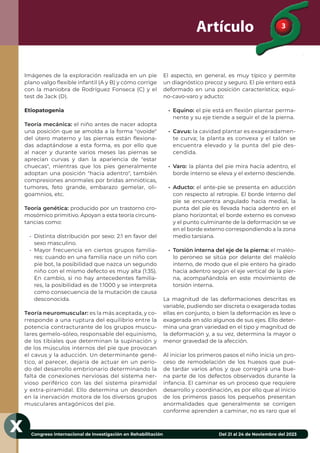 Congreso Internacional de Investigación en Rehabilitación Del 21 al 24 de Noviembre del 2023
3
3
Artículo 3
X
Imágenes de la exploración realizada en un pie
plano valgo ﬂexible infantil (A y B) y cómo corrige
con la maniobra de Rodríguez Fonseca (C) y el
test de Jack (D).
Etiopatogenia
Teoría mecánica: el niño antes de nacer adopta
una posición que se amolda a la forma "ovoide"
del útero materno y las piernas están ﬂexiona-
das adaptándose a esta forma, es por ello que
al nacer y durante varios meses las piernas se
aprecian curvas y dan la apariencia de "estar
chuecas", mientras que los pies generalmente
adoptan una posición "hacia adentro", también
compresiones anormales por bridas amnióticas,
tumores, feto grande, embarazo gemelar, oli-
goamnios, etc.
Teoría genética: producido por un trastorno cro-
mosómico primitivo. Apoyan a esta teoría circuns-
tancias como:
• Distinta distribución por sexo: 2:1 en favor del
sexo masculino.
• Mayor frecuencia en ciertos grupos familia-
res: cuando en una familia nace un niño con
pie bot, la posibilidad que nazca un segundo
niño con el mismo defecto es muy alta (1:35).
En cambio, si no hay antecedentes familia-
res, la posibilidad es de 1:1000 y se interpreta
como consecuencia de la mutación de causa
desconocida.
Teoría neuromuscular: es la más aceptada, y co-
rresponde a una ruptura del equilibrio entre la
potencia contracturante de los grupos muscu-
lares gemelo-sóleo, responsable del equinismo,
de los tibiales que determinan la supinación y
de los músculos internos del pie que provocan
el cavus y la aducción. Un determinante gené-
tico, al parecer, dejaría de actuar en un perío-
do del desarrollo embrionario determinando la
falta de conexiones nerviosas del sistema ner-
vioso periférico con las del sistema piramidal
y extra-piramidal. Ello determina un desorden
en la inervación motora de los diversos grupos
musculares antagónicos del pie.
El aspecto, en general, es muy típico y permite
un diagnóstico precoz y seguro. El pie entero está
deformado en una posición característica; equi-
no-cavo-varo y aducto:
• Equino: el pie está en ﬂexión plantar perma-
nente y su eje tiende a seguir el de la pierna.
• Cavus: la cavidad plantar es exageradamen-
te curva; la planta es convexa y el talón se
encuentra elevado y la punta del pie des-
cendida.
• Varo: la planta del pie mira hacia adentro, el
borde interno se eleva y el externo desciende.
• Aducto: el ante-pie se presenta en aducción
con respecto al retropie. El borde interno del
pie se encuentra angulado hacia medial, la
punta del pie es llevada hacia adentro en el
plano horizontal; el borde externo es convexo
y el punto culminante de la deformación se ve
en el borde externo correspondiendo a la zona
medio tarsiana.
• Torsión interna del eje de la pierna: el maléo-
lo peroneo se sitúa por delante del maléolo
interno, de modo que el pie entero ha girado
hacia adentro según el eje vertical de la pier-
na, acompañándola en este movimiento de
torsión interna.
La magnitud de las deformaciones descritas es
variable, pudiendo ser discreta o exagerada todas
ellas en conjunto, o bien la deformación es leve o
exagerada en sólo algunos de sus ejes. Ello deter-
mina una gran variedad en el tipo y magnitud de
la deformación y, a su vez, determina la mayor o
menor gravedad de la afección.
Al iniciar los primeros pasos el niño inicia un pro-
ceso de remodelación de los huesos que pue-
de tardar varios años y que corregirá una bue-
na parte de los defectos observados durante la
infancia. El caminar es un proceso que requiere
desarrollo y coordinación, es por ello que al inicio
de los primeros pasos los pequeños presentan
anormalidades que generalmente se corrigen
conforme aprenden a caminar, no es raro que el
 
