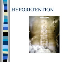 HYPORETENTION
 