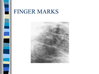 FINGER MARKS
 