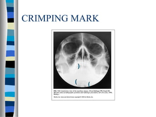 CRIMPING MARK
 