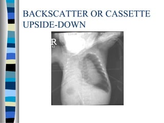 BACKSCATTER OR CASSETTE
UPSIDE-DOWN
 