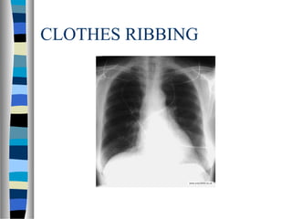 CLOTHES RIBBING
 