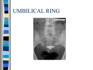 UMBILICAL RING
 