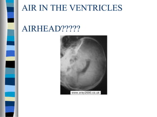 AIR IN THE VENTRICLES
AIRHEAD?????
 