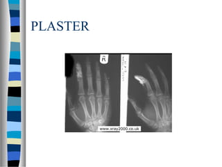 PLASTER
 