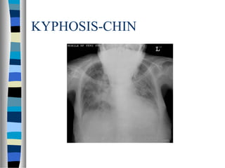 KYPHOSIS-CHIN
 