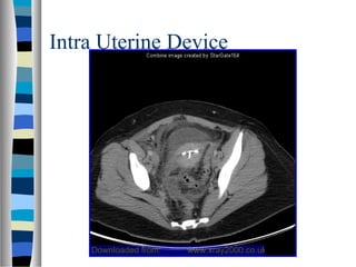 Intra Uterine Device
 