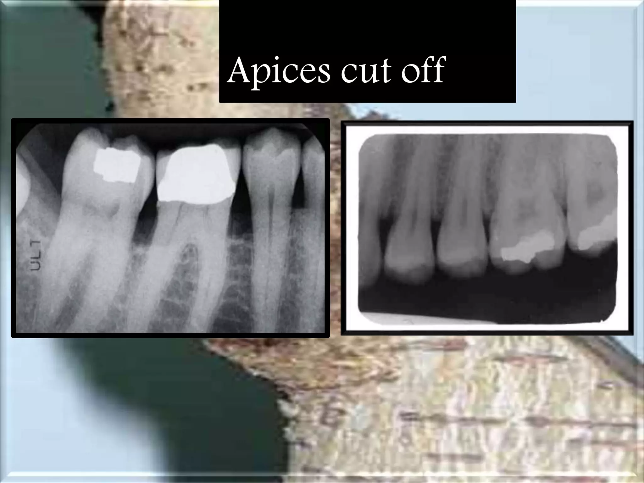 Artifact and errors in intraoral periapical radiograph.ppt