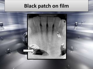 Artifact and errors in intraoral periapical radiograph.ppt