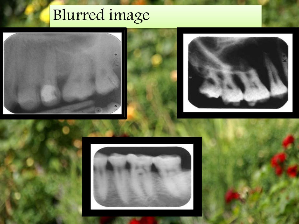 Artifact and errors in intraoral periapical radiograph.ppt