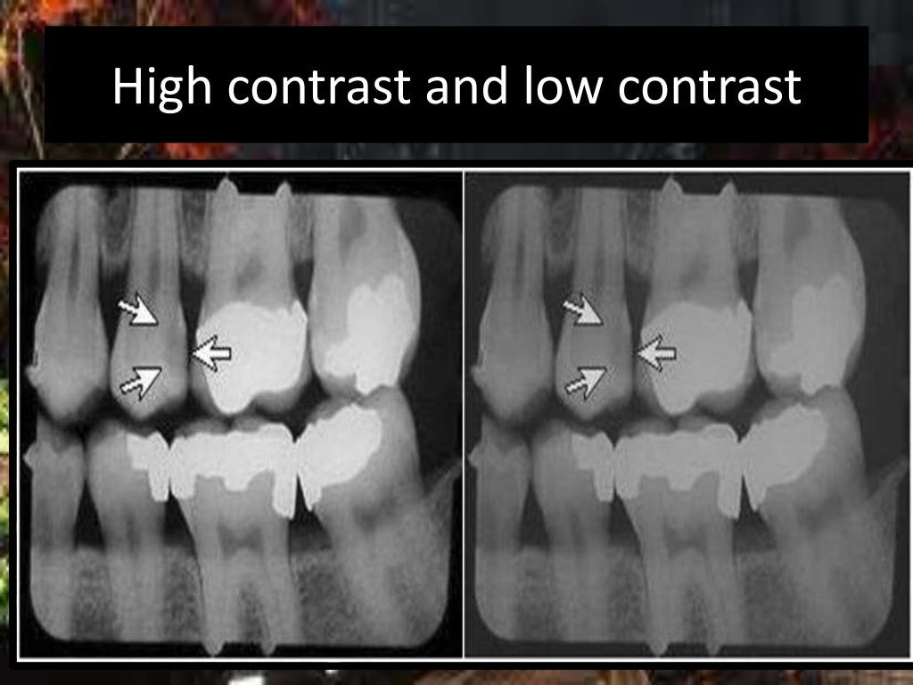 Artifact and errors in intraoral periapical radiograph.ppt