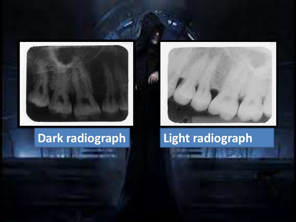 Artifact and errors in intraoral periapical radiograph.ppt