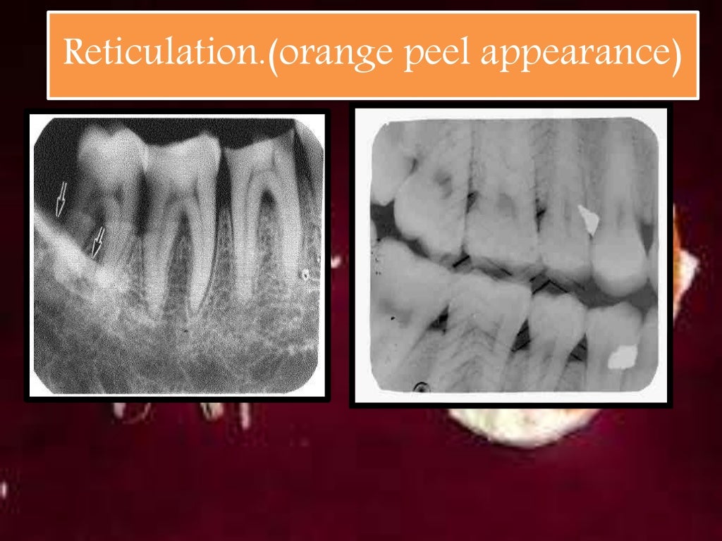 Artifact and errors in intraoral periapical radiograph.ppt