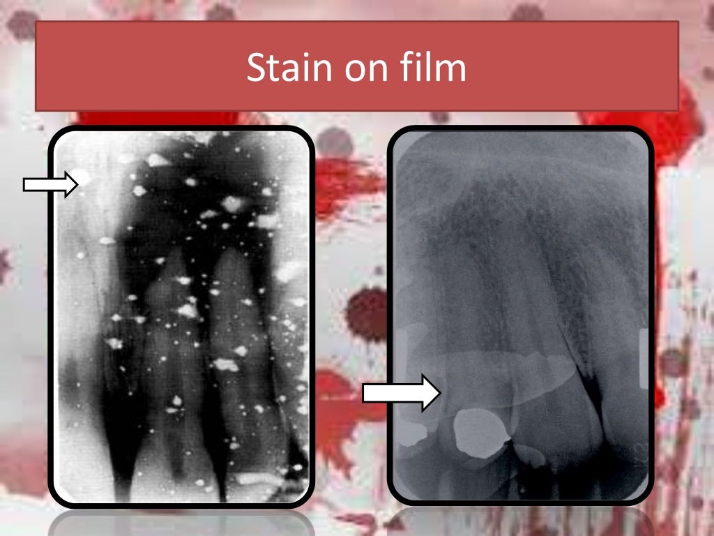 Artifact and errors in intraoral periapical radiograph.ppt