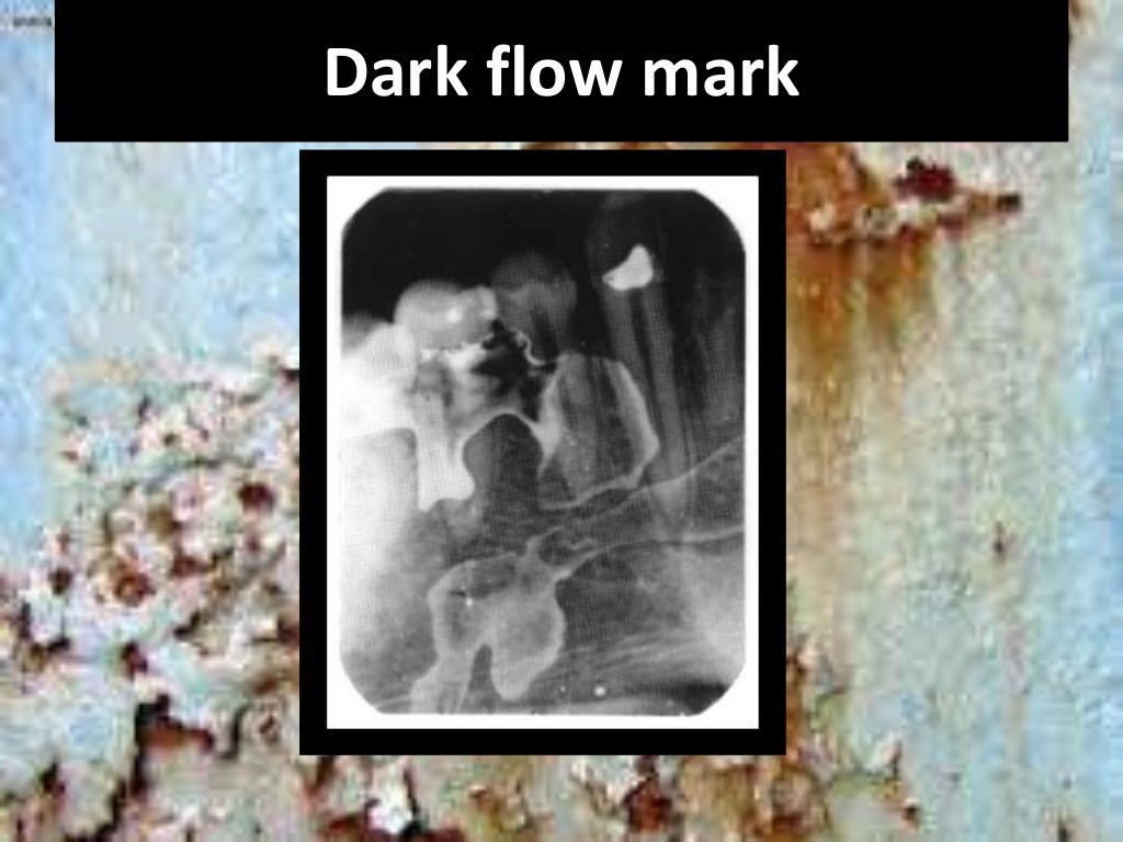 Artifact and errors in intraoral periapical radiograph.ppt