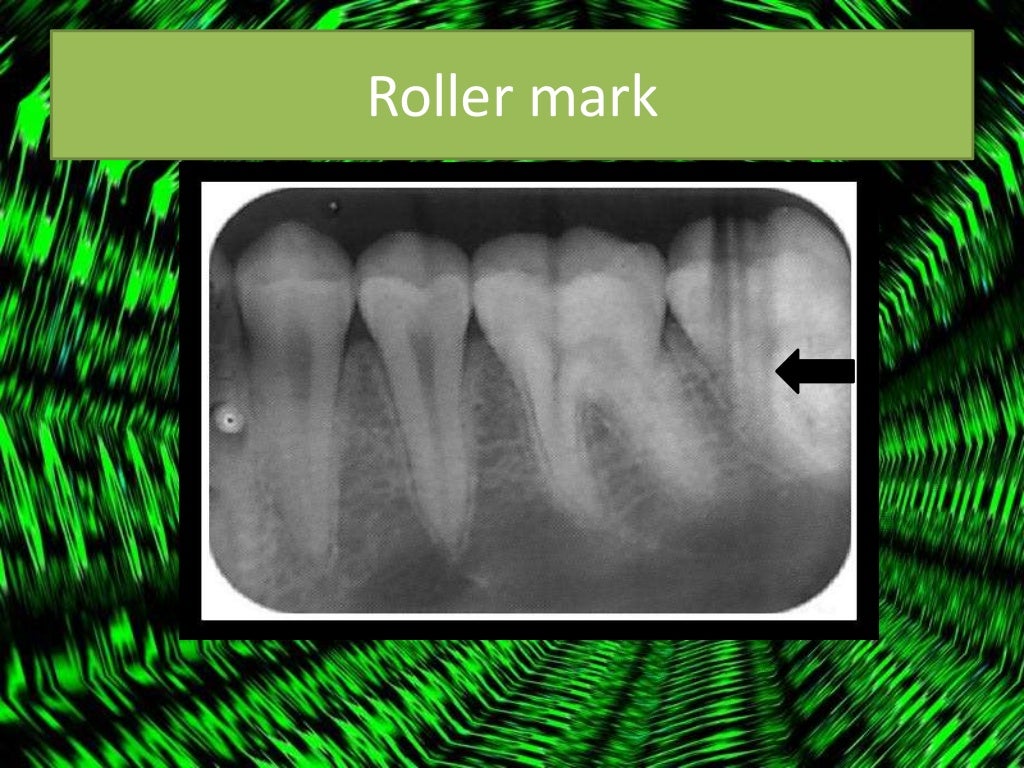 Artifact and errors in intraoral periapical radiograph.ppt