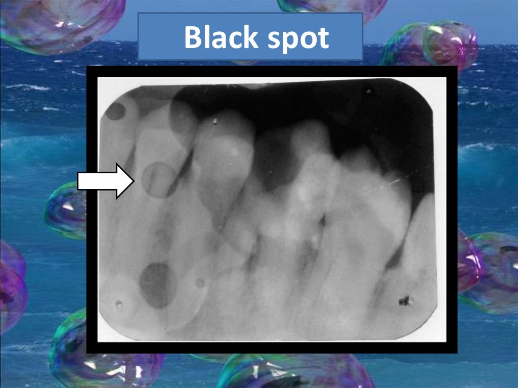 Artifact and errors in intraoral periapical radiograph.ppt