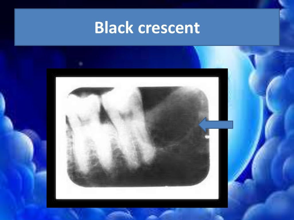 Artifact and errors in intraoral periapical radiograph.ppt