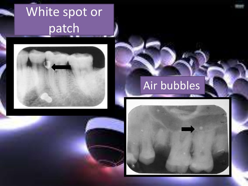 Artifact and errors in intraoral periapical radiograph.ppt