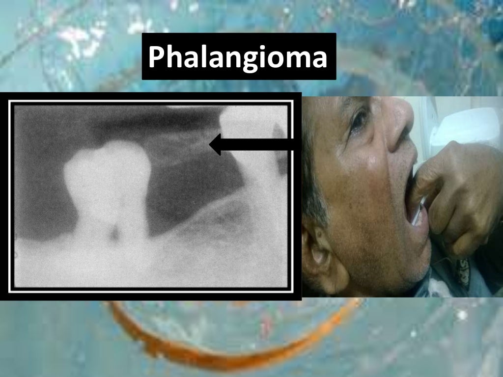 Artifact and errors in intraoral periapical radiograph.ppt