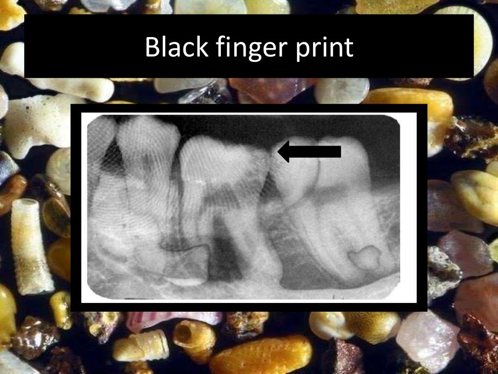 Artifact and errors in intraoral periapical radiograph.ppt