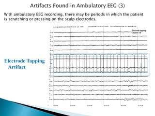 Artifact removal from ambulatory eeg | PPTX