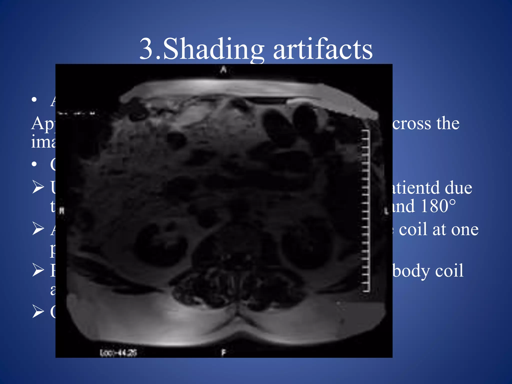 3.Shading artifacts
• Appearance:
Appears as a difference in the signal intrnsity across the
imaging volume
• Causes :
 Uneven excitation of the nuclei within the patientd due
to the RF applied at flip angle less than 90° and 180°
 Abnormal loading of the coil or coupling the coil at one
point
 Patient anatomy touching at one side of the body coil
and coupling at that point
 Overflow of ADC
 